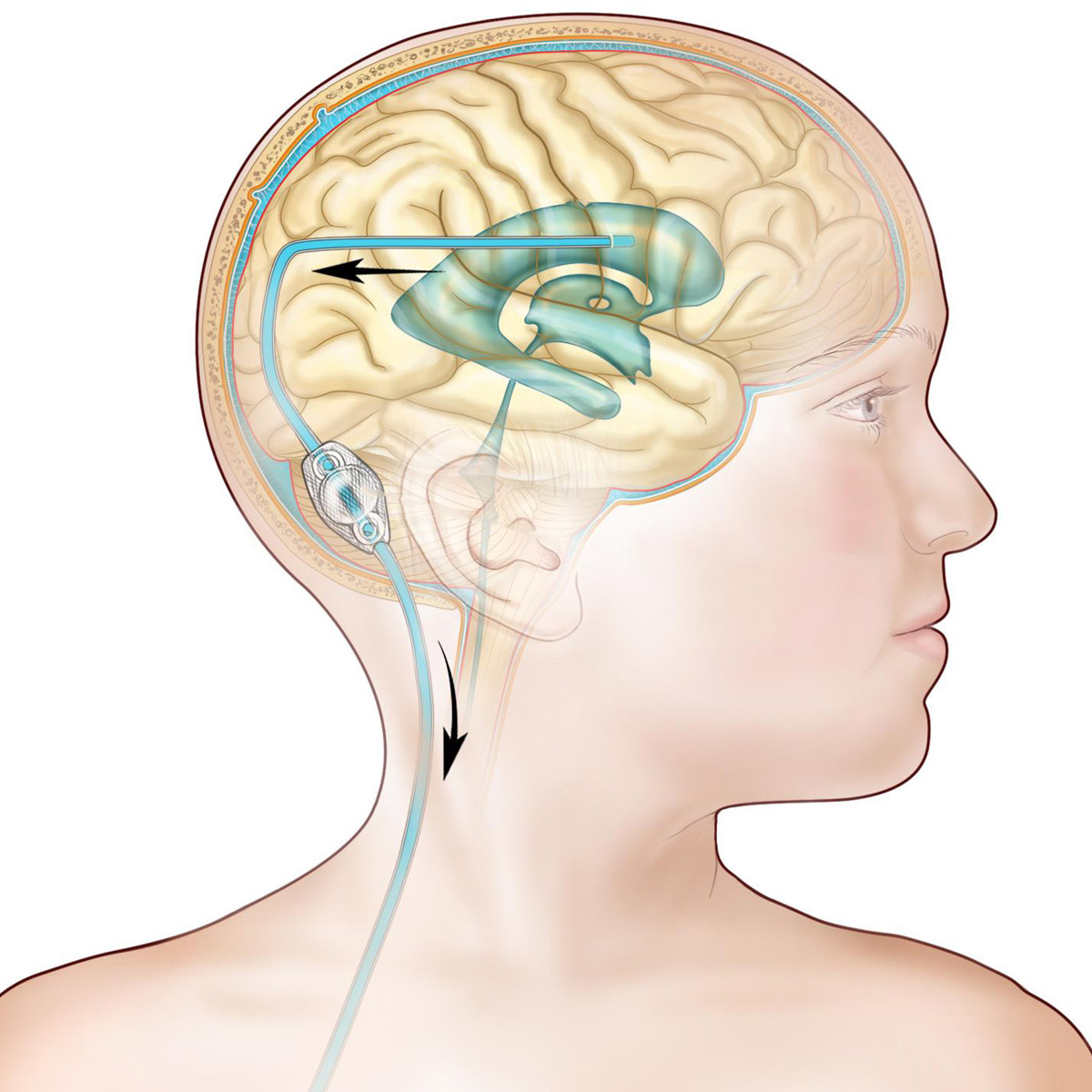 Hidrocefalia adultos e crianças