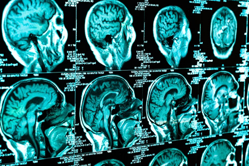 Trauma crânio encefálico e suas consequências